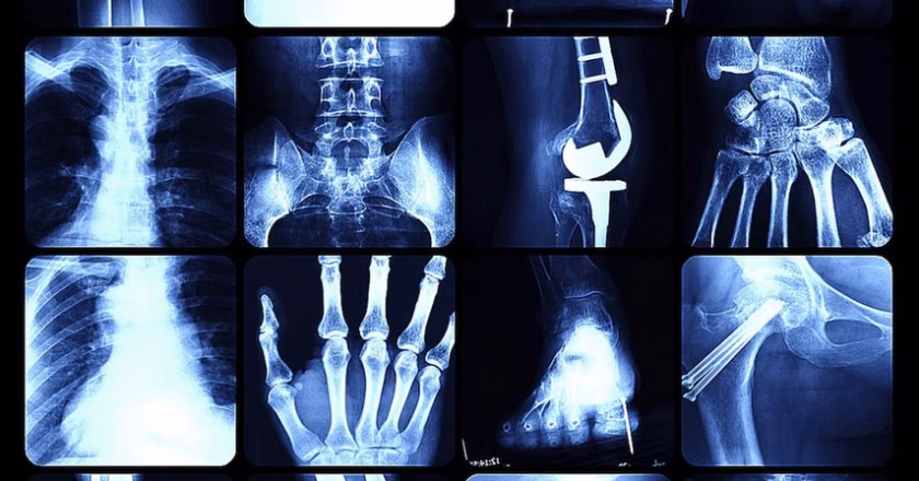 Día Mundial de la Osteoporosis promueve la prevención y el cuidado de la salud ósea